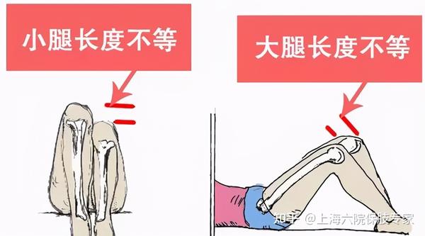 【文根四肢矫形科普系列】长短腿怎么办?可以矫形吗?