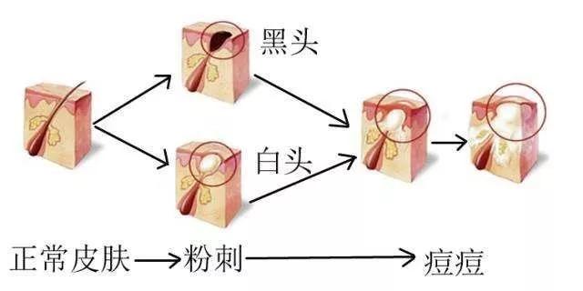 白头复黑头一头未去一头又起本期讲解皮肤白头黑头如何去除