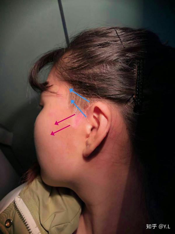 耳前瘘管引流 手术