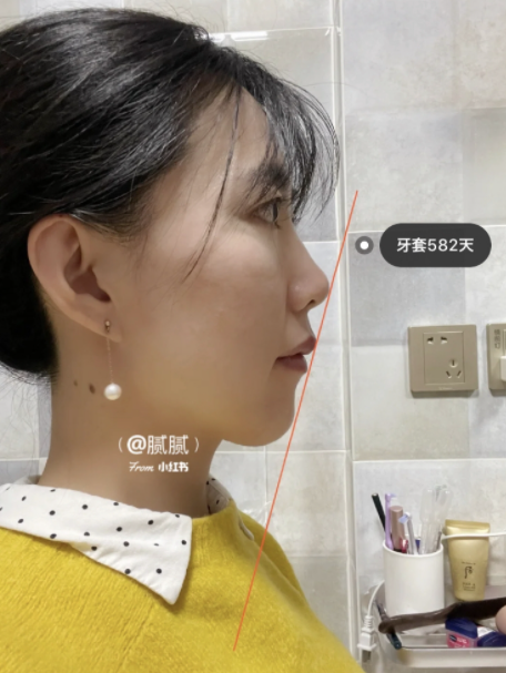 第596天,敢于尝试侧面拍照了.整容先整牙,骨性嘴凸也有救.