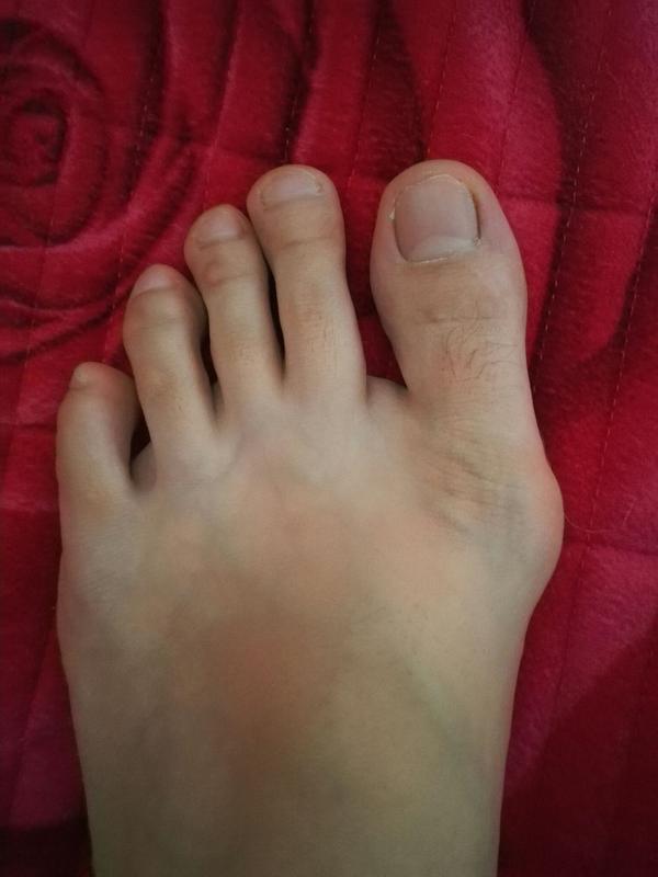 作为一个女生脚拇指外翻是一种怎样的体验