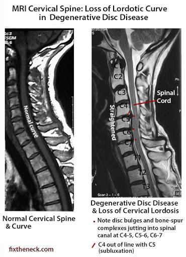 臂丛牵拉试验 压头试验 x-ray 颈椎间盘突出 颈椎病,颈椎后纵韧带钙化