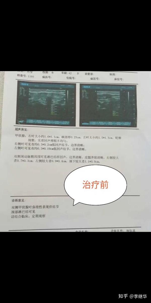 桥本氏病并发甲状腺结节患者恢复病例分享