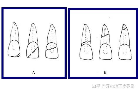 牙断了怎么办?