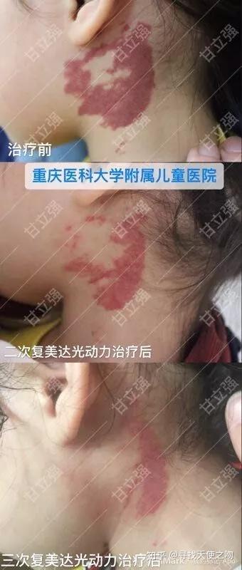 复美达光动力治疗鲜红斑痣疗效展示