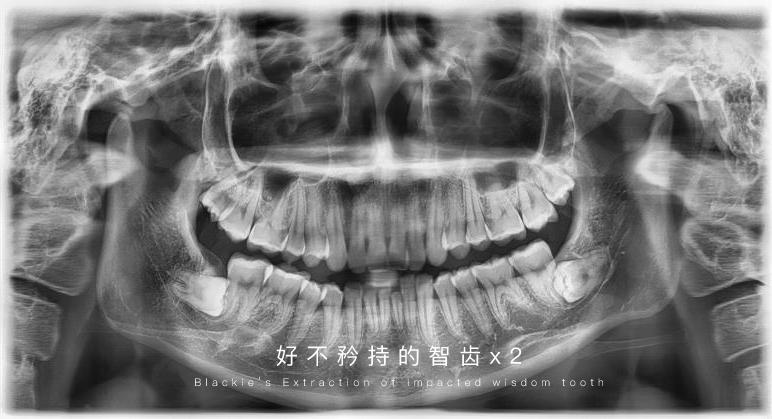 侃一侃拔除低位阻生智齿的亲身经历