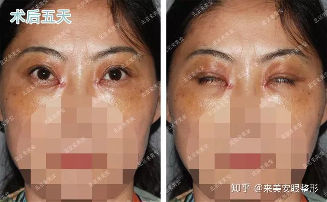度减少,上眼睑凹陷和下眼睑松垮得到改善;刚刚拆完线,眼角有些发红