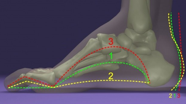 什么是高足弓?