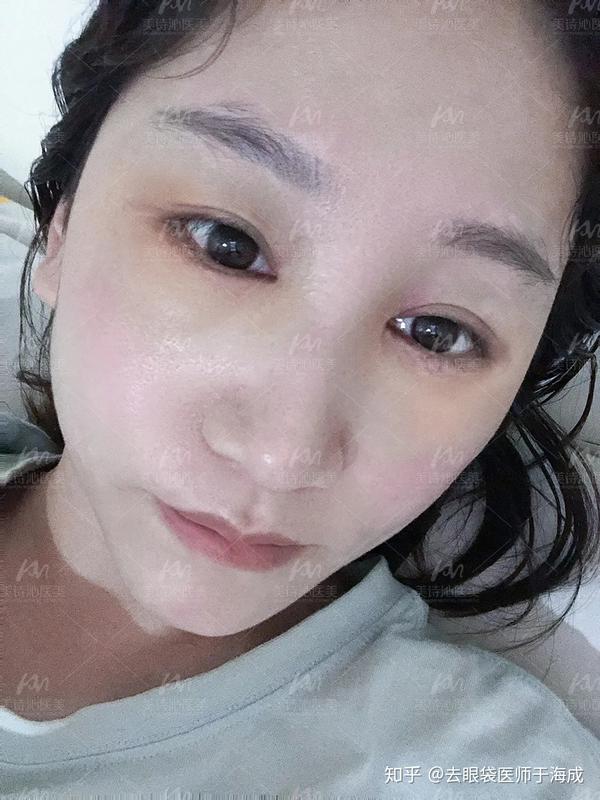 25岁女白领自述:14张素颜照告诉你去眼袋全过程!