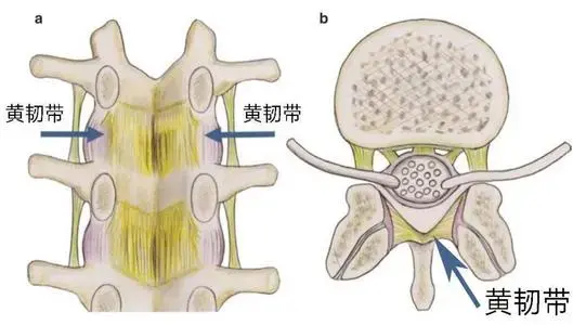 当患者腰部椎体稳定性较差时,就会引起腰脱,使腰椎管矢状径变细,如