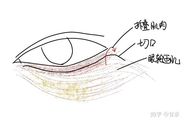 手术折叠眼轮匝肌形成卧蚕    图片为本人手绘