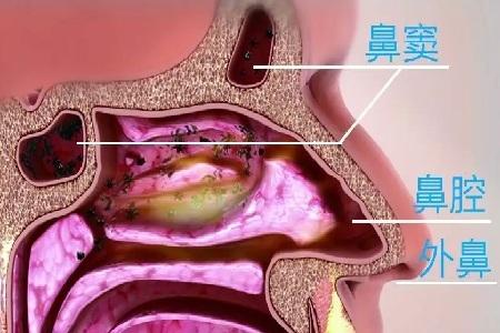 首大崔付军:鼻窦囊肿包括那些类型