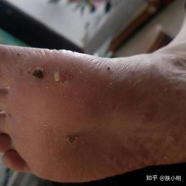跖疣为什么会复发?