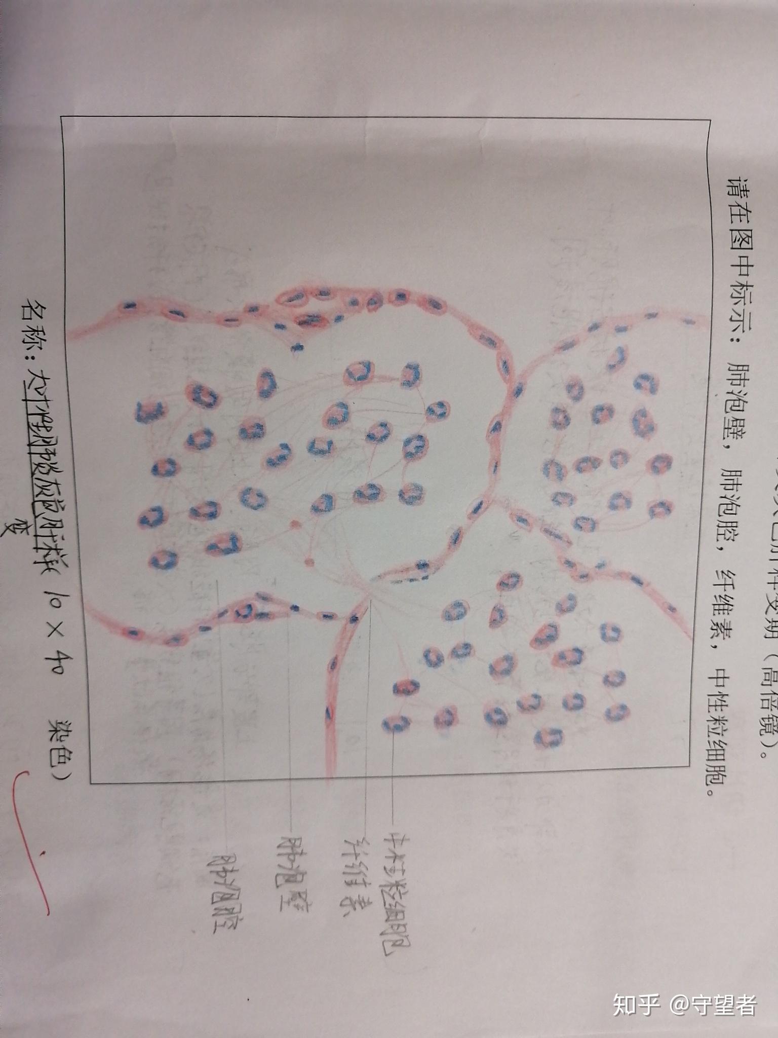 红蓝铅笔大叶性肺炎图怎么画