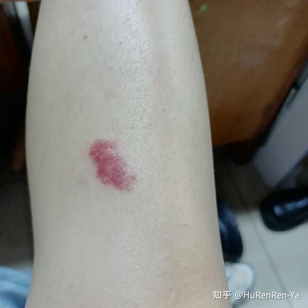 这是螨虫咬的吗?
