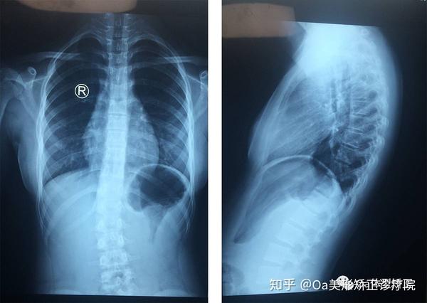 孩子总是含胸驼背,看看是否是因为脊柱侧弯 ?