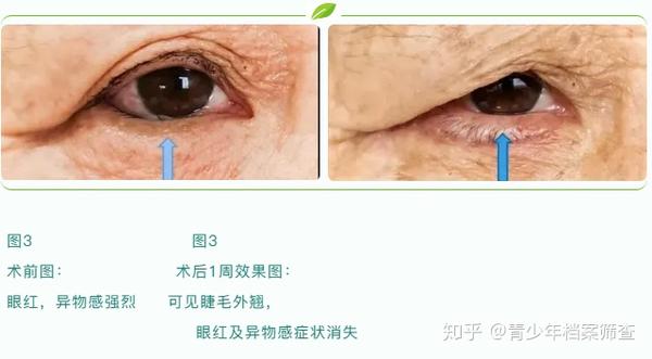 01老年性 睑内翻 常发生于下睑,由于年龄增加,皮肤肌肉眶隔松弛,使得