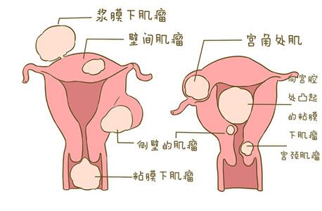 得了子宫肌瘤会影响怀孕吗