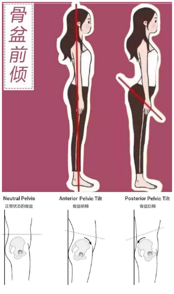 四,骨盆前倾