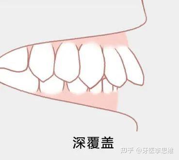 矫正牙齿中的深覆合和深覆盖有什么区别呢