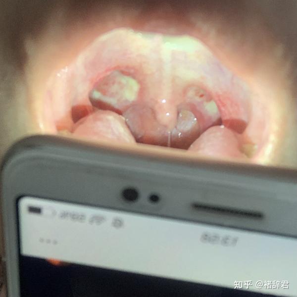 记一次扁桃体切除