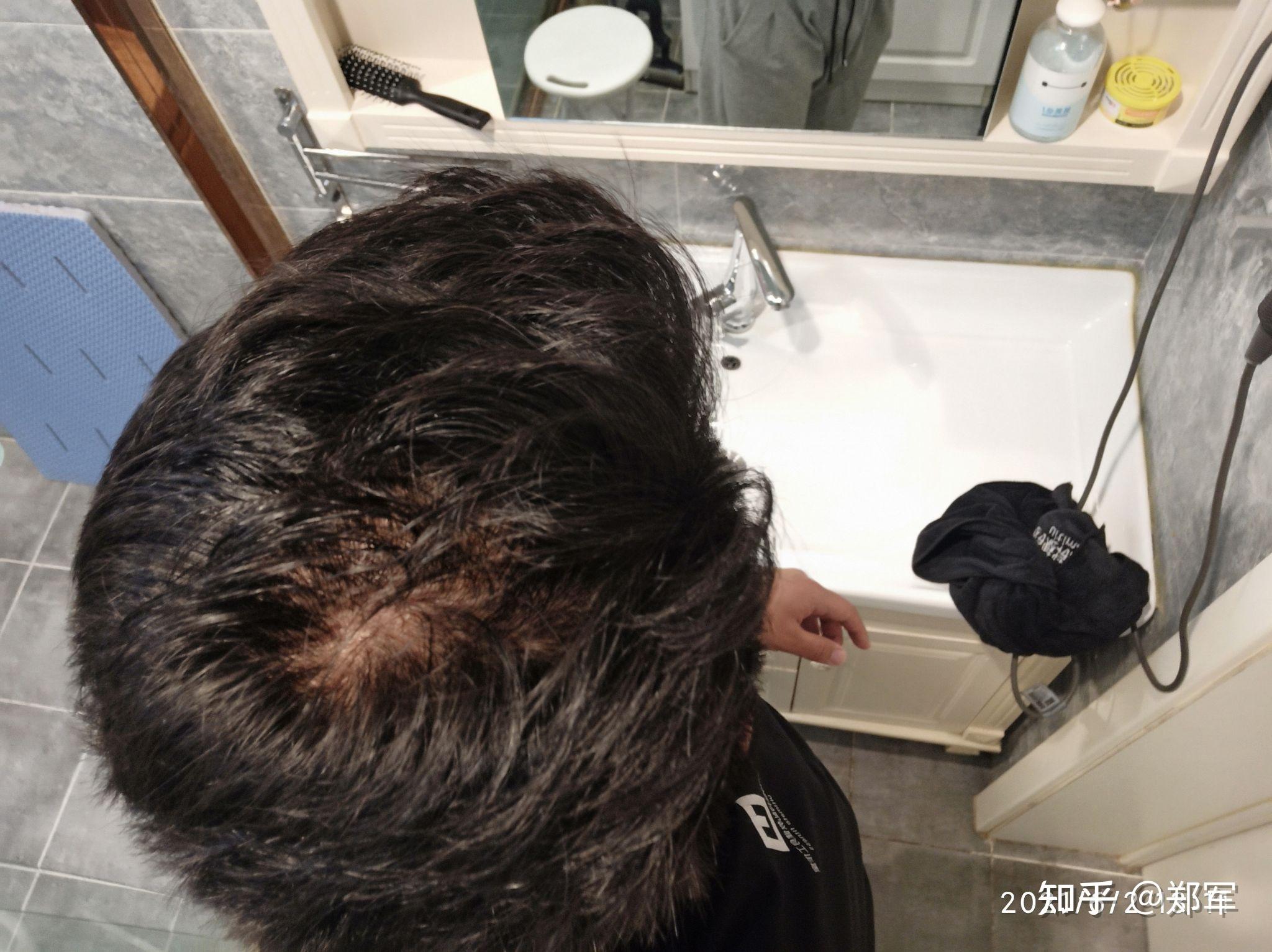 我这头顶漩涡处头发量正常吗