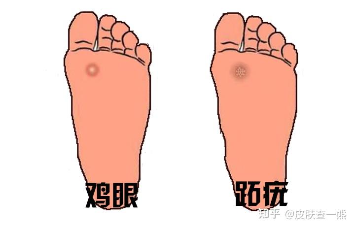 老查宝典鸡眼跖疣足疣3步辨别解决