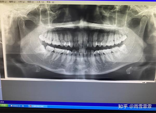 20多岁分两次拔掉四颗智齿是什么样的一种体验?