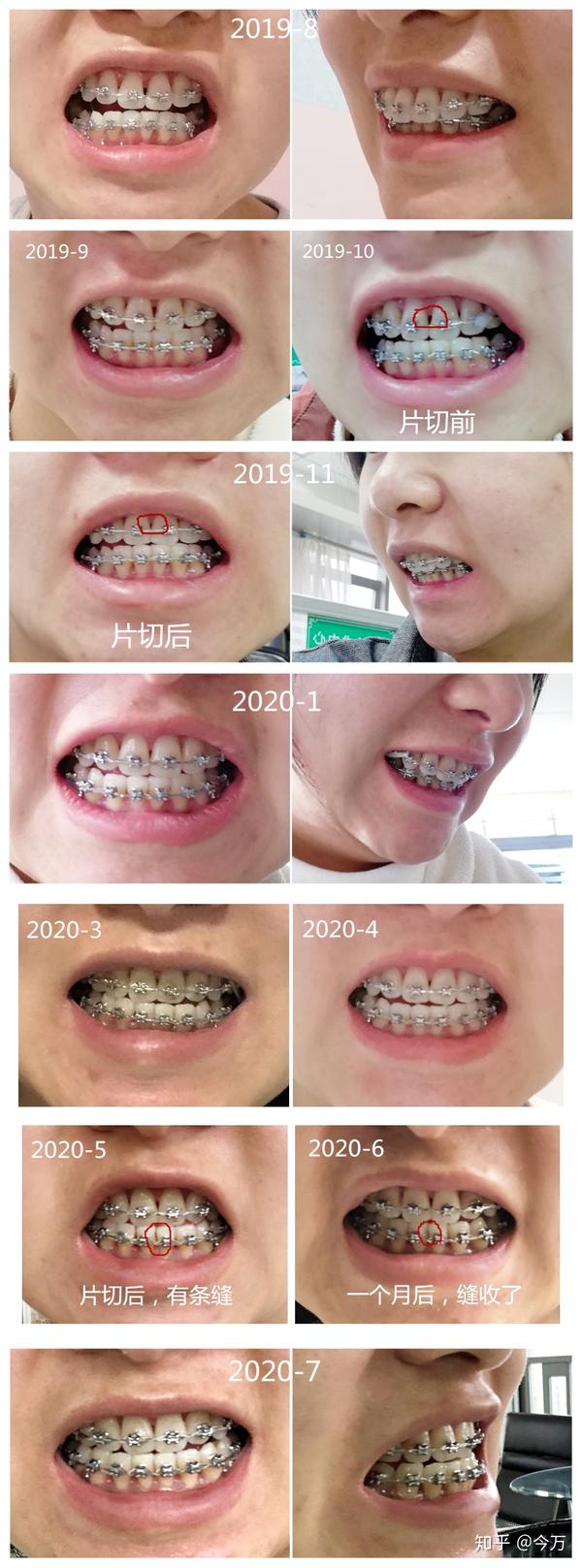 24岁牙齿矫正过程,照片对比经验分享