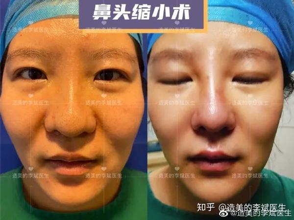 鼻头缩小难道就是切除组织就能变小那么简单吗?