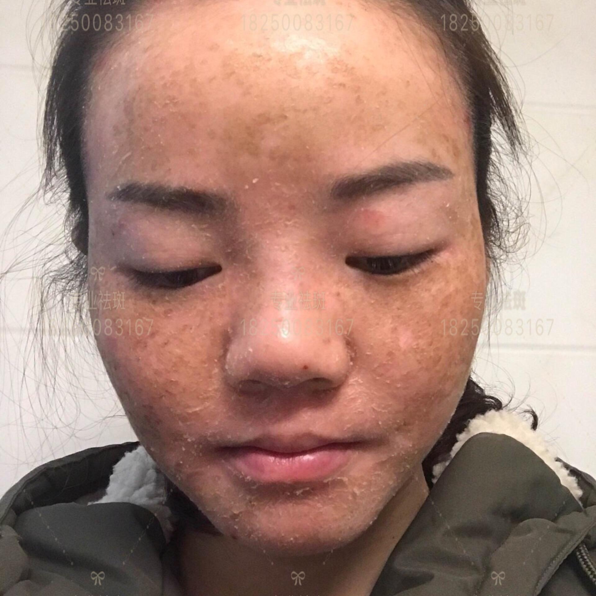 液氮冷冻祛斑的一个过程,第5张是揭膜后,第6第7张是色素回流后使用