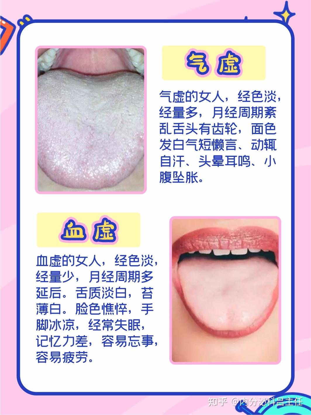 肝气郁结:一般人的舌头是椭圆,而肝气郁结的人舌头是尖的,舌尖和舌边