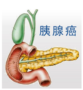 太多人死于胰腺癌身体出现4种异样你可能离它有点近了