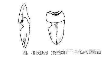 牙齿楔状缺损一般有什么症状呢?