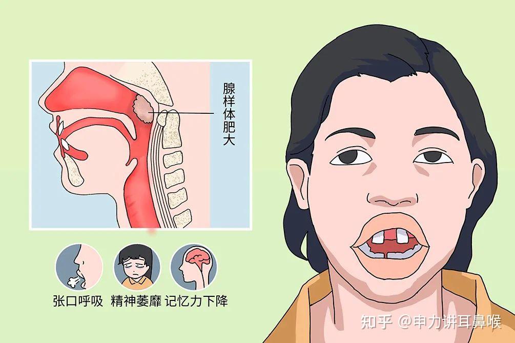 缺氧,影响孩子的智力发育;腺样体肥大对孩子的危害:用嘴巴呼吸的后果