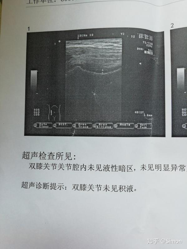 膝关节积液是吸收完了但腿有时还会涨疼