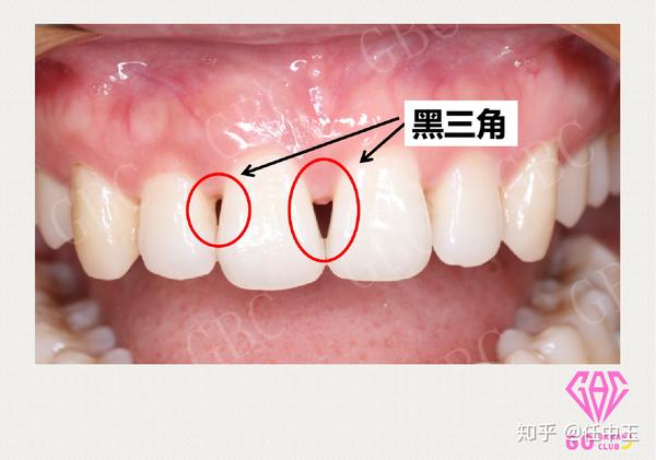 口腔科普 揭秘传说中的牙齿"黑三角"