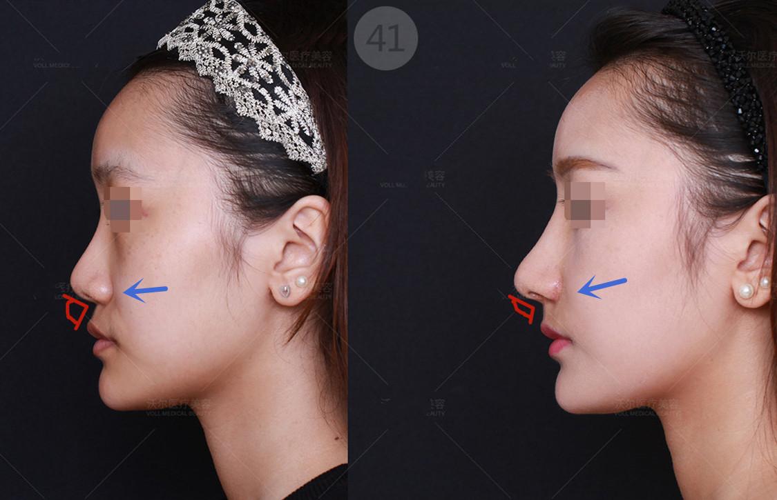 为什么要填充鼻基底重视鼻基底凹陷凸嘴法令纹问题