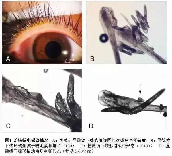 1 052例睑缘炎患者中发现蠕形螨感染者582例,阳性率为55.3%.