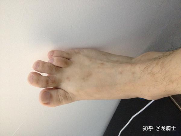 我的脚趾短小治疗经历分享第一四跖骨短小