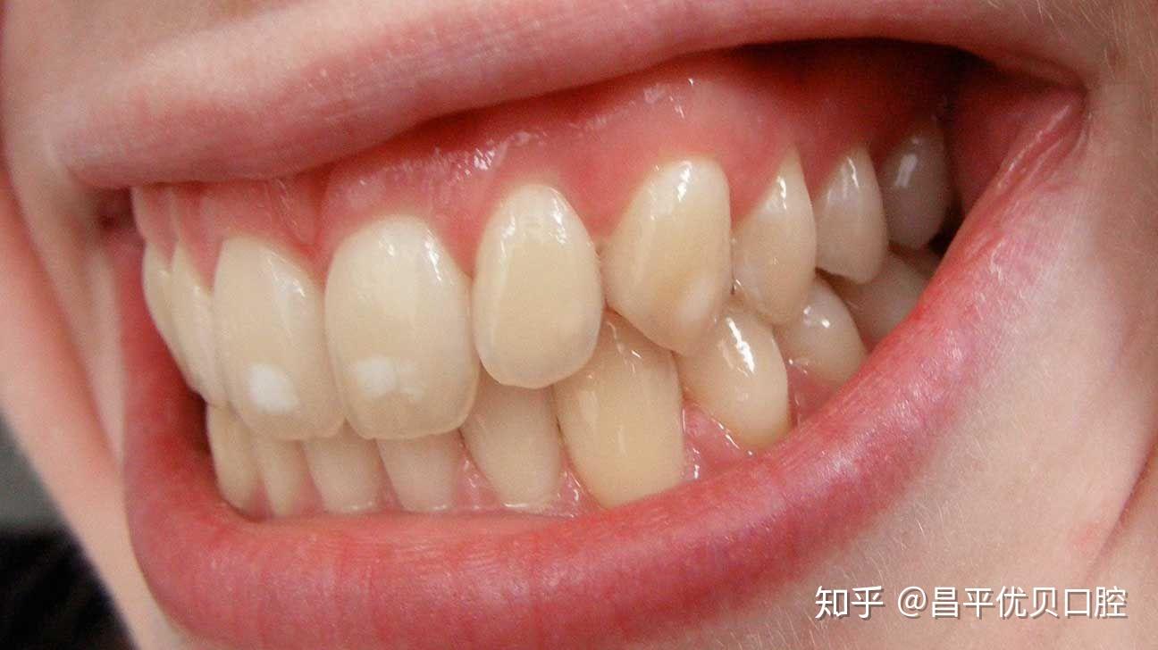 但有时候,牙齿上会出现像白斑一样的变色.
