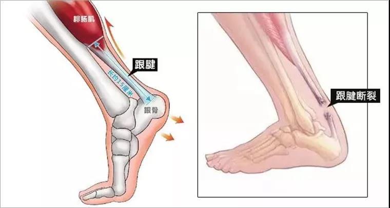 跟腱断裂要怎么治疗?