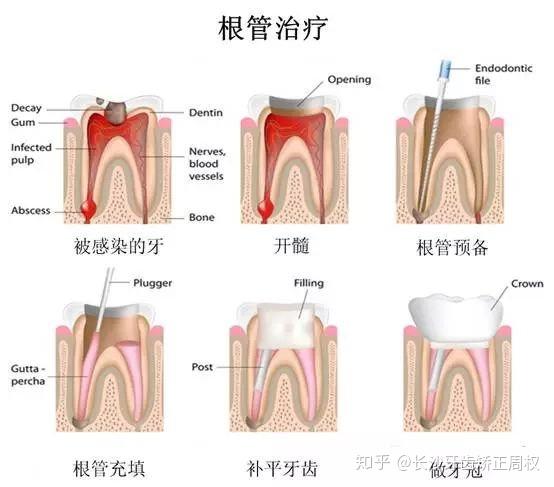 牙根长度仍足够长的话,可以保留牙根,经过根管治疗可打桩做