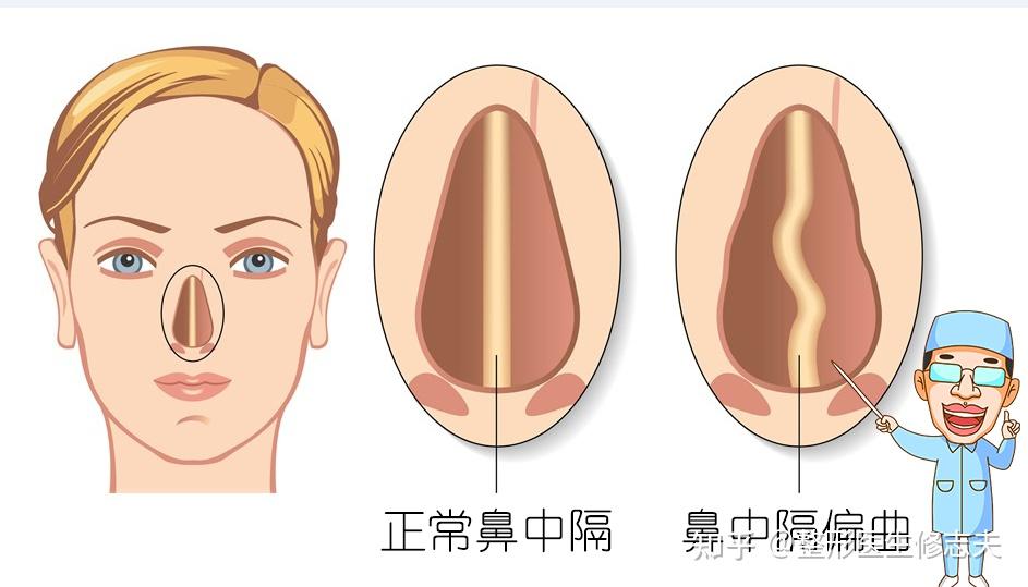 鼻中隔略左偏是什么意思