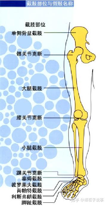 最佳的截肢部位决定安装假肢后的完美效果