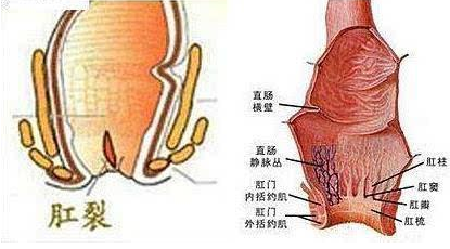 肛裂和痔疮的区别