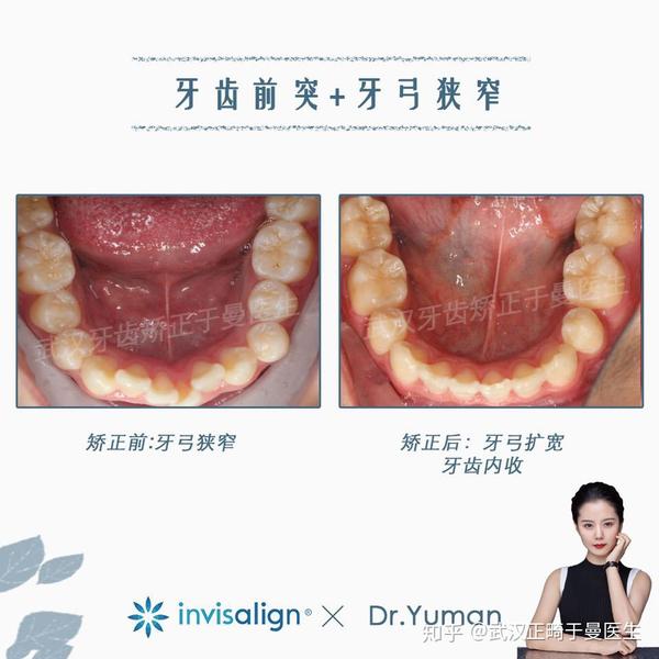 牙弓狭窄多发生于牙弓中段即前磨牙区,上下颌扩弓治疗时牙弓宽度增加