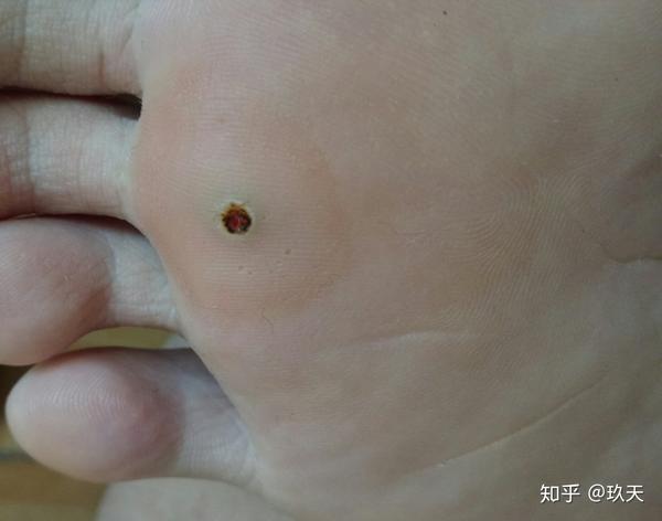 脚上感染长了疣,怎么弄.