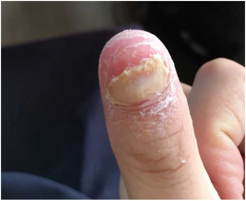 灰指甲是可以治好的,不必担心,只是真菌感染而已,并不是国外有很多