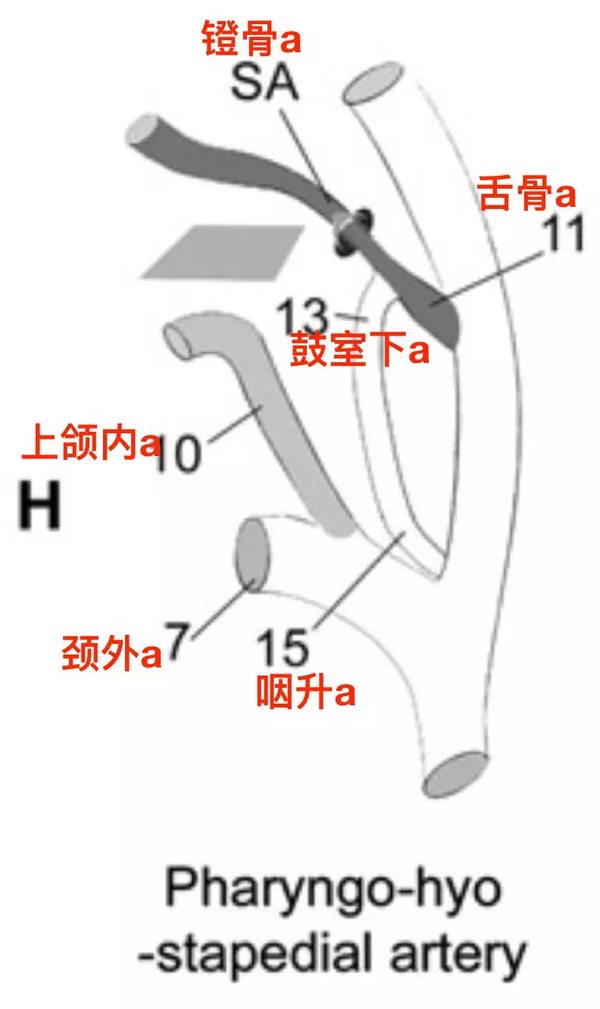 ⑷ 颈内动脉异常走行伴永存镫骨动脉(the stapedial artery with